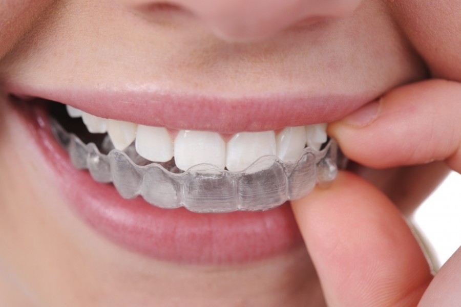 All about Invisalign dental braces - Dental Clinic A-Dent