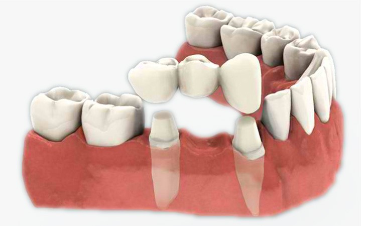  Sve što trebate znati o zubnim krunicama i mostovima