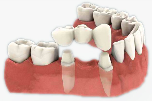  Sve što trebate znati o zubnim krunicama i mostovima